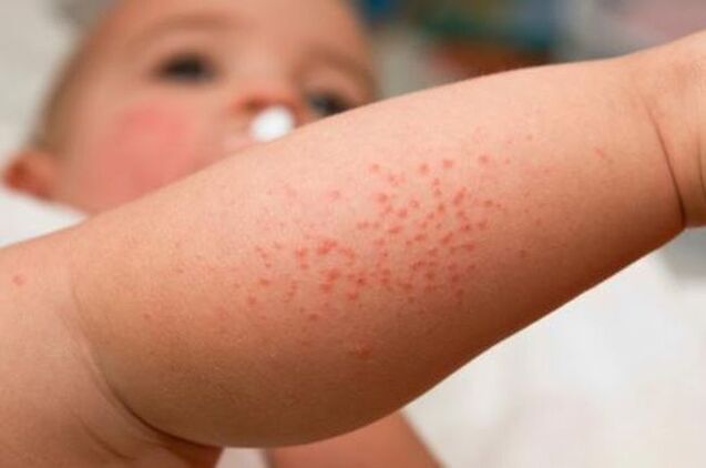 rash due to parasites