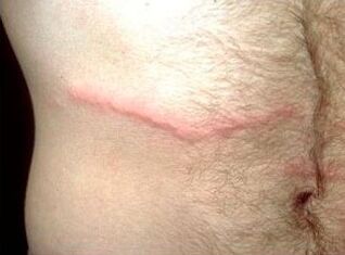 How to get rid of subcutaneous parasites in humans