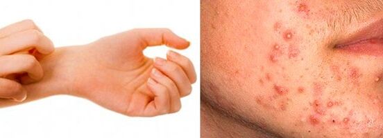 Symptoms of subcutaneous parasites in humans