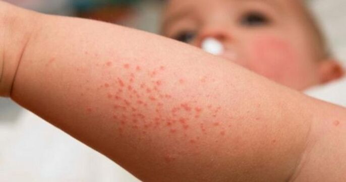 rash as a symptom of a parasitic infection