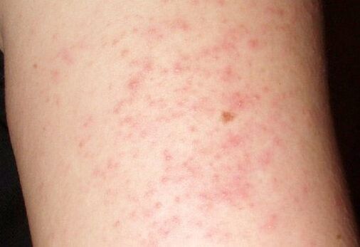 Itchy rashes are a symptom of worms in the liver